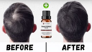 How to Use Finasteride for Hair loss [upl. by Prudhoe599]