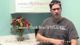 Liposuction vs Tummy Tuck Do I need a Liposuction or Tummy Tuck [upl. by Adlee]