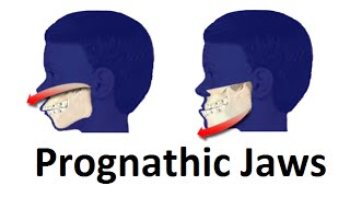 Treatment of Prognathic Jaw Jaw Pushing Forward by Prof John Mew [upl. by Nered]