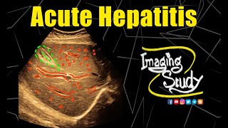 Acute Hepatitis  Ultrasound  Case 304 [upl. by Dobbins]