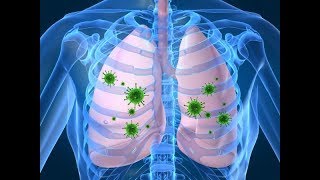 8 síntomas de la pulmonía que no puedes ignorar [upl. by Fax]