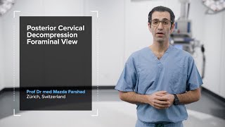 SpeedPearl Posterior Cervical Endoscopic Foraminotomy—Foraminal View [upl. by Peterec114]