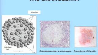 What is Sarcoidosis  Adam Morgenthau MD Mt Sinai Medical Center [upl. by Atsirc]