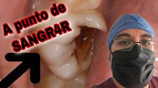 👄Caries CERCA del NERVIO 🚨 bases para protección pulpar💙 [upl. by Keiko429]