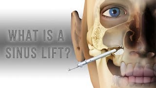 What is a sinus lift [upl. by Ynoep]