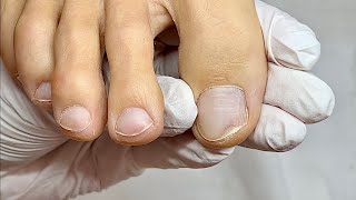 How to cut out a separated nail onycholysis [upl. by Drareg]