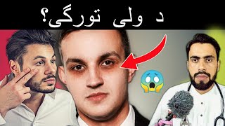 Why Eyes dark circles create Periorbital Hyperpigmentation in Pashto by Dr Mustaqeem [upl. by Arrio]