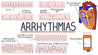 Understanding Arrhythmias [upl. by Vanderhoek]