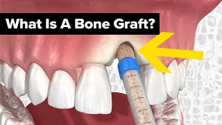 Dental Bone Grafts Explained [upl. by Boot]