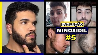 EVOLUÇÃO DE INSCRITOS  MINOXIDIL 5 [upl. by Hairakcaz]