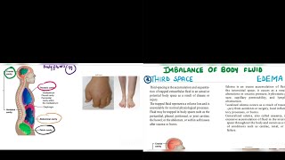 Edema  Third space  Imbalance of Fluids  Saunders [upl. by Nedearb]