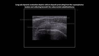 Supraspinatus calcific tendinopathy on shoulder ultrasound [upl. by Falda]