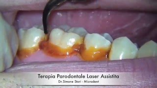 Terapia Parodontale Laser Assistita [upl. by Malilliw]