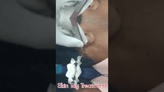 Skin tag removal treatment [upl. by Izaak]