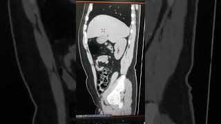 Nephrocalcinosis nephrocalcinosisctscan kidney noncontrastctscankub [upl. by Hairahcez]