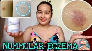 HOW TO TREAT NUMMULAR ECZEMA PHILIPPINES [upl. by Savior]