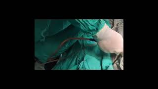 gynecomastia surgery in jaipur by Dr Anoop Sharma certified plastic surgeon [upl. by Annoeik]