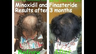 Minoxidil and Finasteride Results after 3 Months Usage [upl. by Lesh]