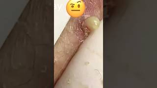 Wow yellow water blackheads  spa  acne  blackheads [upl. by Asihtal]