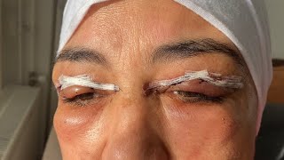 Drooping eyelid surgery عملية شد الجفون [upl. by Vasyuta192]