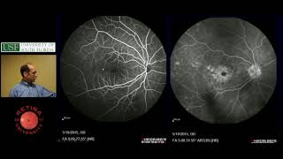 Subretinal Fluid  Ophthalmology Resident Lecture  April 2018 [upl. by Hau358]