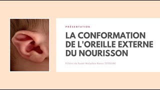 La conformation de loreille externe du nourrisson [upl. by Lewendal]