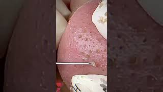 Skincare  Blackheads Removal 174 skincare skincare blackheads blackheads [upl. by Ko]