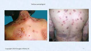 Dermatology Wk1WedSpr20 Bullous pemphigoid Psoriasis and histology review of the skin [upl. by Ammann]