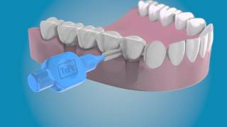 Clean the sides of your dental implants with a TePe Interdental Brush [upl. by Anital130]