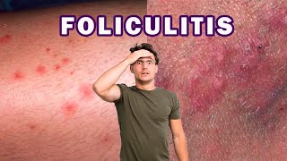 CÓMO ELIMINAR LA FOLICULITIS INFECCIOSA  BACTERIANA [upl. by Ttebroc]