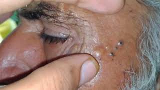 blackheads elderly this weeks 2024  sac be spa old age blackheads 2024  sac be spa face today 250 [upl. by Ahsiekim]