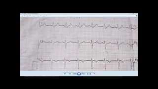 ECG LEFT ANTERIOR FASCICULAR BLOCK [upl. by Yahsram]