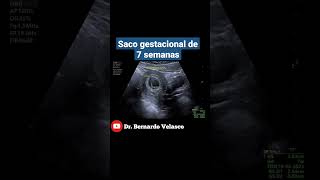 SACO GESTACIONAL DE 7 SEMANAS DE GESTACIÓN [upl. by Riobard]