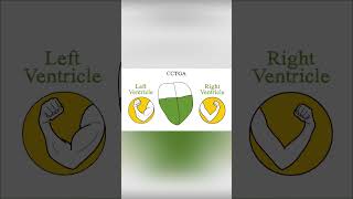 Congenitally corrected transposition of the great arteries CCTGA [upl. by Eahsal]