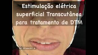 TENS NO TRATAMENTO DA DTM [upl. by Ivie]