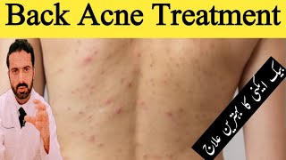 Treatment of Back Acne Shoulder Acne and Chest Acne in Urdu  Get Rid Of Back Acne  Dr Nadeem Rph [upl. by Tressia]