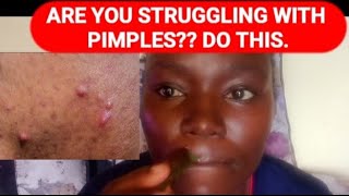 DO AWAY WITH PIMPLES THE NATURAL WAY [upl. by Etsirhc]