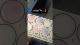 Serological practical WIDAL test typhoidfeverwidal test practical pathologyshorts statuslab [upl. by Irac990]