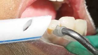 Aquacut Velopex Fluid Abrasion in ClassV cavities [upl. by Wardlaw]