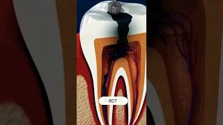 🦷Root canal treatment 📞9799841764 📞🦷Drpritidental youtube youtubeshorts shortvideo [upl. by Efren]