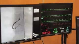 Cardiac Catheterisation Part 2  Right Coronary [upl. by Danyette519]