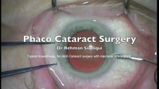 Phaco Cataract Surgery High Definition HD [upl. by Nueovas716]