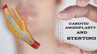 Symptomatic right carotid stenosis treated by carotid angioplasty and stenting [upl. by Curhan394]