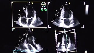 Triplane Echokardiographie triplane echocardiography [upl. by Aldrich]