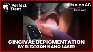 Gingival Depigmentation by elexxion nano diode LASER [upl. by Drarej]