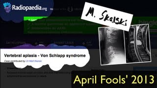 Radiopaediaorg April Fools Case 2013  Von Schlapp disease [upl. by Noyes]