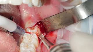 Extraction of a partially erupted 38 wisdom tooth [upl. by Lidstone925]