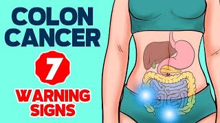 7 Warning Signs of Colon Cancer in 2024 [upl. by Baun]