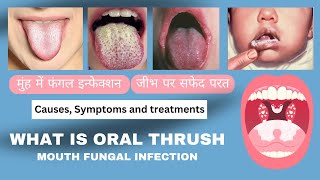 मुंह में फंगल इन्फेक्शन जीभ पर सफेद परत What is oral thrush mouth fungal infection [upl. by Eitra]