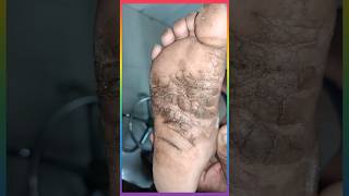 पैरो के तलवे की चमडी का रोग plantar keratoderma viralshorts [upl. by Naihr786]